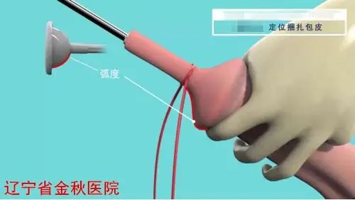 金秋健康科普关注生殖健康带您了解一次性包皮环切吻合器手术