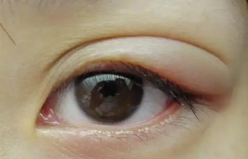 眼睑长个硬块是麦粒肿吗_健康经验_快速问医生_有问必答