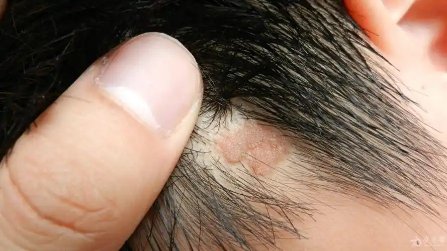 请问头部的这块突起的皮肤是什么皮肤病