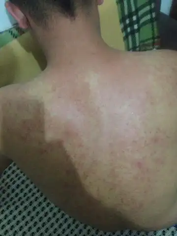 喝酒后背红一片_百度知道