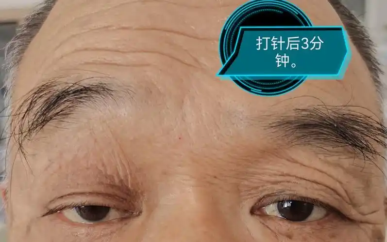 一老年患者眼皮下垂,检查发现竟然是重症肌无力.