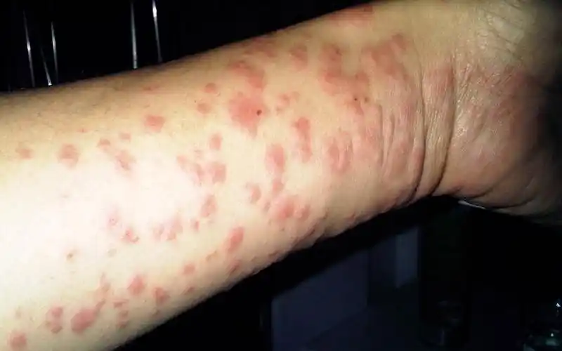 湿疹发作越来越频繁怎么办?过来人分享方法,用一次就见效!