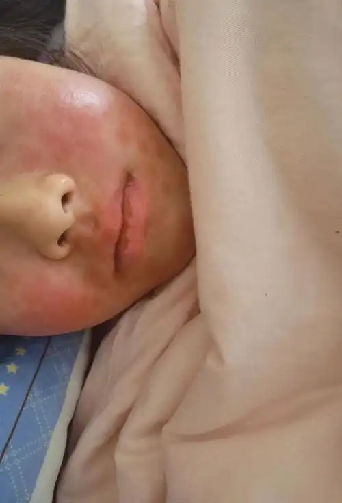 儿童雾化面部严重过敏,慎用乙酰半胱氨酸