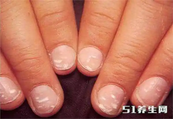 指甲的这四个现象不要忽视,可能是癌症的前兆