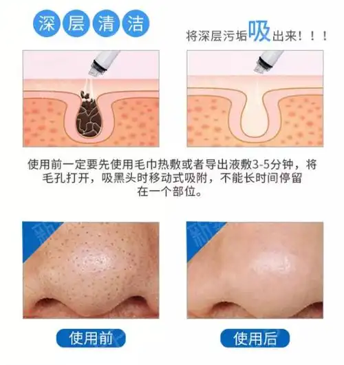 小气泡清洁后注意事项