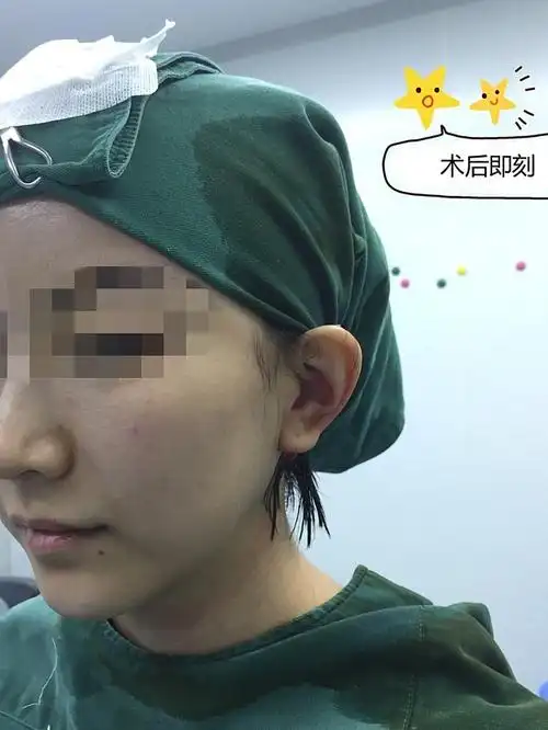 反骨耳做精灵耳手术挑战第10天#医生没有特意改变_圈子-新氧美容整形