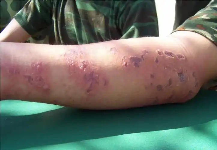 夏季常见皮肤病的防治_日光性皮炎_日光性皮炎如何预防 - 好大夫在线