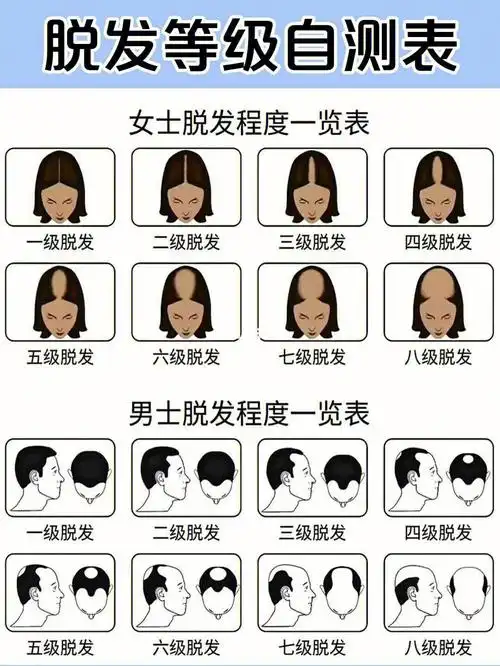 脱发等级自测表脱发的466大原因71