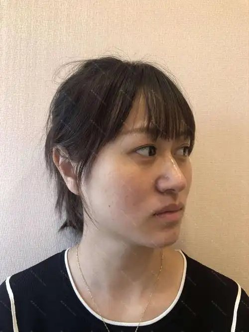 天津哪家医院做玻尿酸垫鼻基底较好?