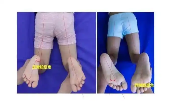 内八字,外八字?孩子脚型正常不正常,家长可以这样判断