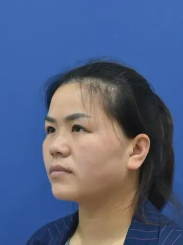 塌鼻梁,鼻基底凹陷,脸大,也许大家都想改变这些.父_圈子-新氧美容整形