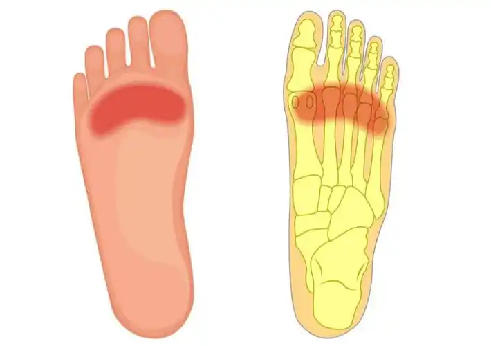 脚疼是怎么回事带你揭秘这几个不同部位疼痛的真相