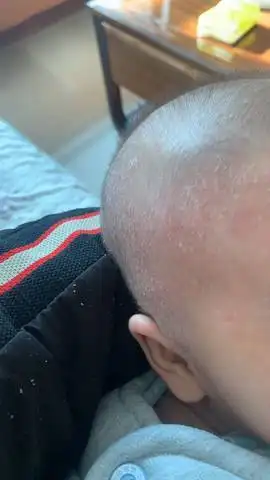 新生儿头上有干皮皮,很多,请教下怎么回事_育儿问答_宝宝树