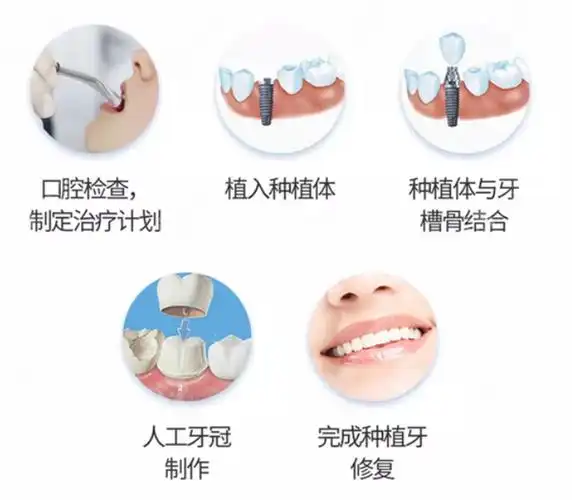 种植牙流程