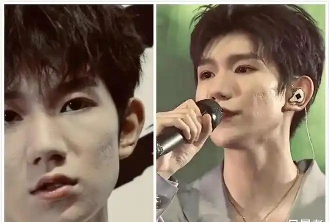 王源真人长啥样满脸坑洼皮肤状态一言难尽网友还好我没抽烟