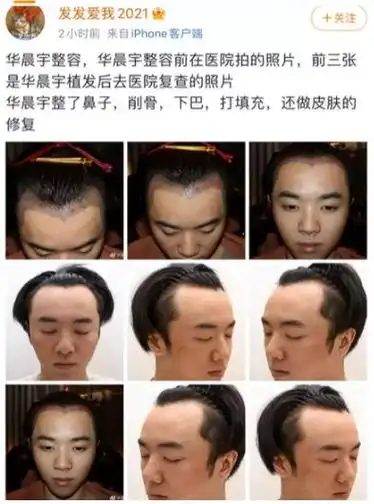 网友爆料称,华晨宇在医院接受植发手术时的照片曝光,可以看出他的发际