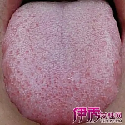 【图】看艾滋病舌苔图片 了解艾滋病的危害性及6大临床表现