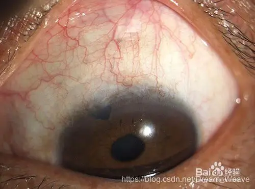 1,眼白属心肺,心火肺热眼睛里就会出现红血丝.