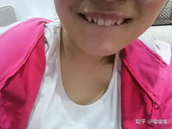 完全长偏了的虎牙