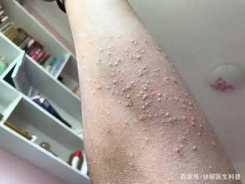 疥疮的出现,跟螨虫有很大的关系,经常会夜间瘙痒,并具有传染性