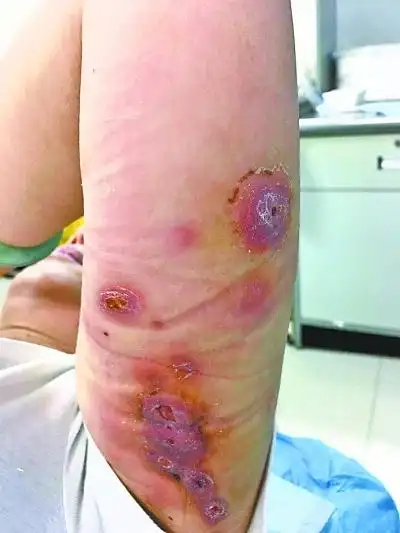 陈女士打溶脂针一星期后多处皮肤溃烂