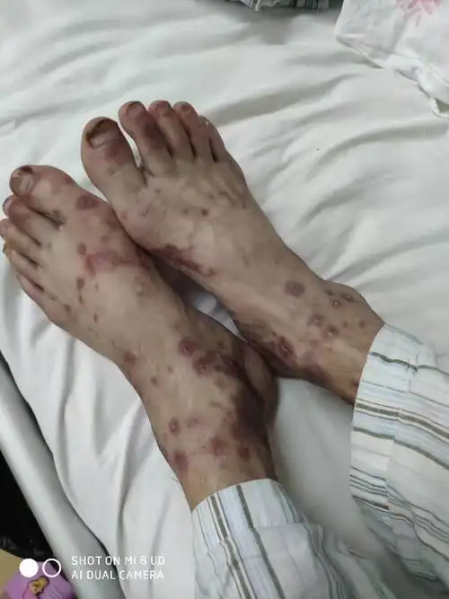 哪位大神说说这是什么皮肤病