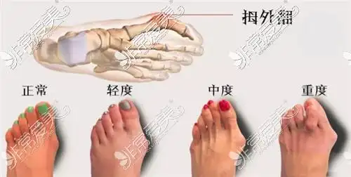 脚拇指外翻手术的利弊分析,看完就知道脚趾外翻有必要做吗!
