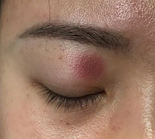 以为眼睛上的皮疹是神经性皮炎看了医生才知道是药物过敏