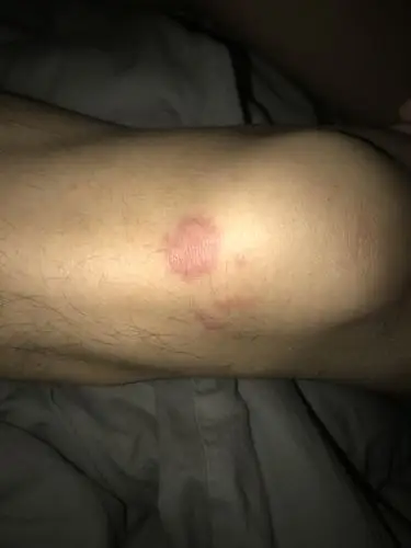 男朋友的小腿上长了一块红斑 有人认识吗?