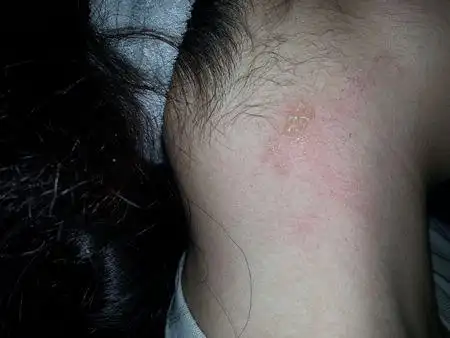 问:脖子长了一些水泡