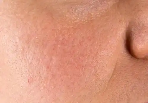 正常情况下,油脂会从毛孔分泌出来,起到保护皮肤的作用, 而毛孔也岁月