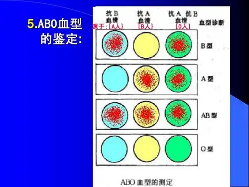 abo血型 abo血型 abo 的鉴定: 的鉴定 源于:[a人 源于:[a人} :[a [b人