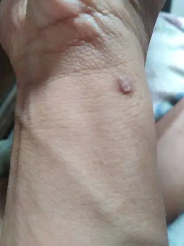 皮肤上长了个肉包,是什么?