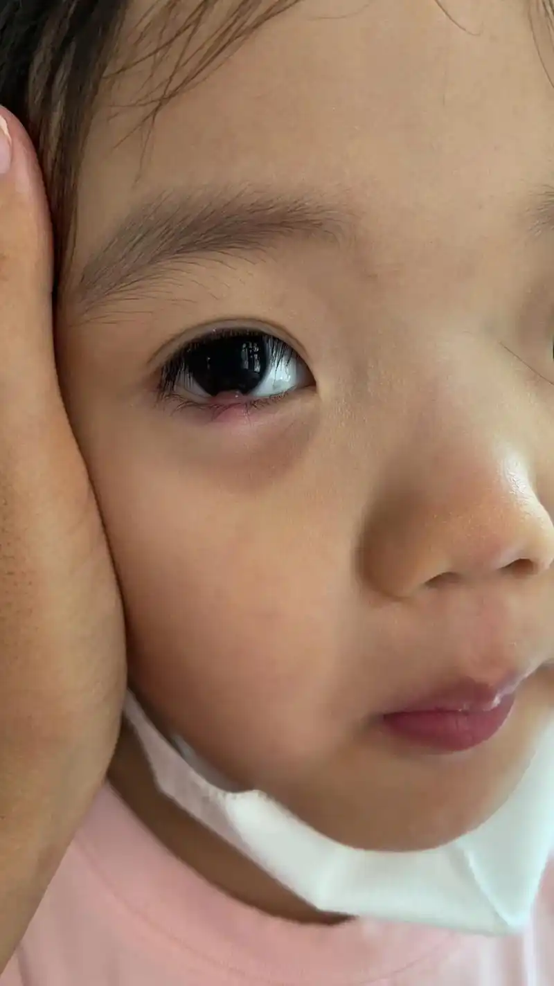 霰粒肿.有没有同款长过霰粒肿(眼睑板囊肿)的宝宝,你们都是怎 - 抖音