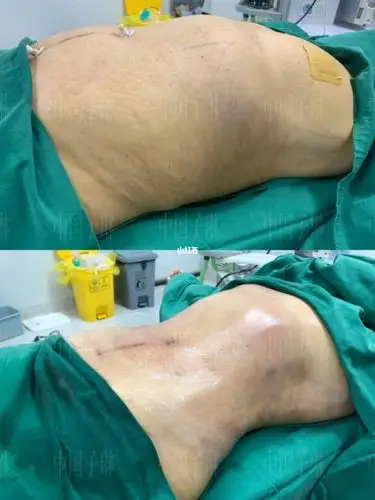 威塑吸脂打造完美的人生,中国子琳,精益求精,例例是精品!