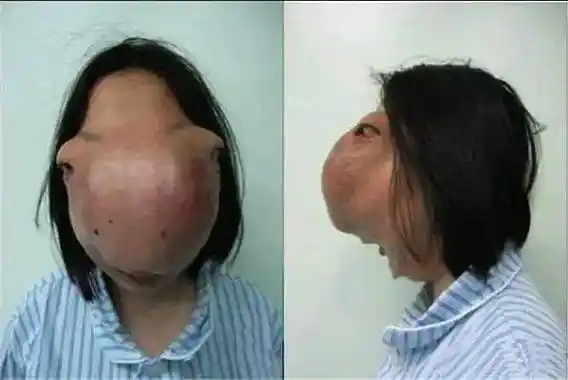 广州出现"马脸女孩",因模样怪异蒙头生活14年,医生掀开盖帘,也吓得