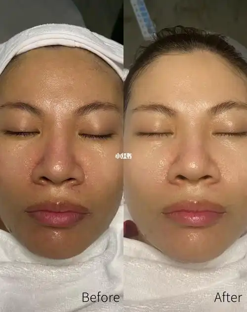 灯泡肌95 一次效果对比 上图,看到即是你所得 概