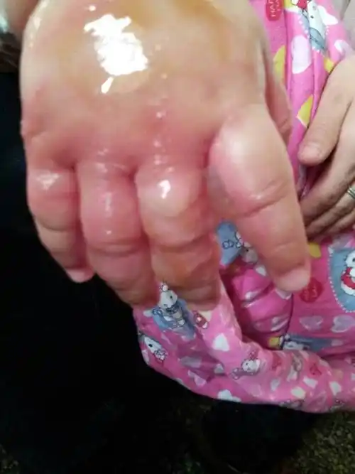 宝宝七个月手被开水烫伤了,起了水泡,擦了美宝,这该怎么办?