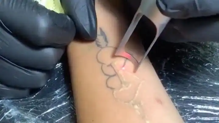 第一次用皮秒洗纹身效果立马看得见洗纹身没有想象中那么疼在无锡用