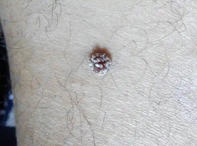 出现疣体(瘊子),要怎么解决?