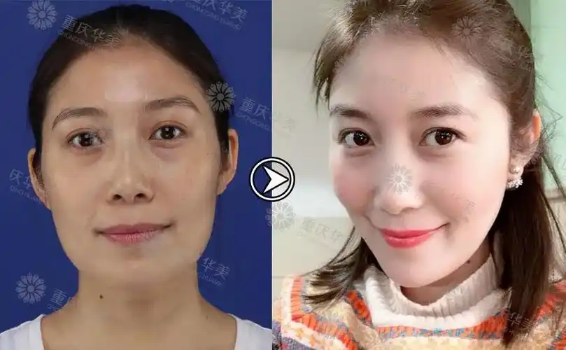 脂肪填充对比图