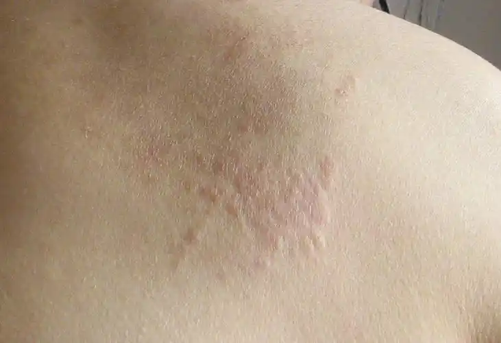 皮肤病 背上长了很多像过敏一样的小包包群_百度知道