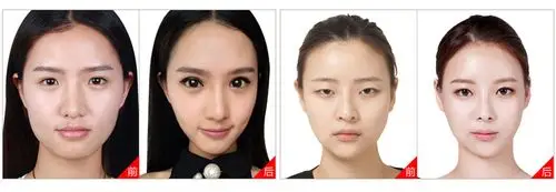 原生态单眼皮者  如眯眯眼,丹凤眼等不理想眼型 做过埋线双眼皮  但