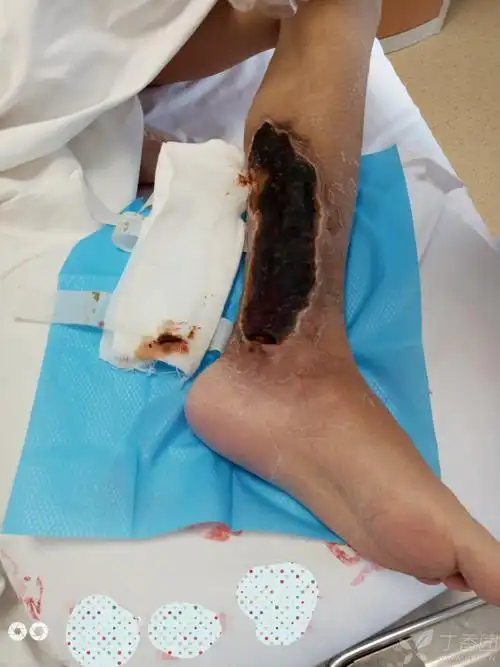 去甲肾上腺素渗漏引起的皮肤坏死 [病例帖]