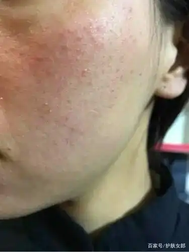 皮肤皮脂膜受损怎么修复?