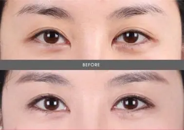 韩国包眼角热议医院分析:gio和eve家,soonplus整形!