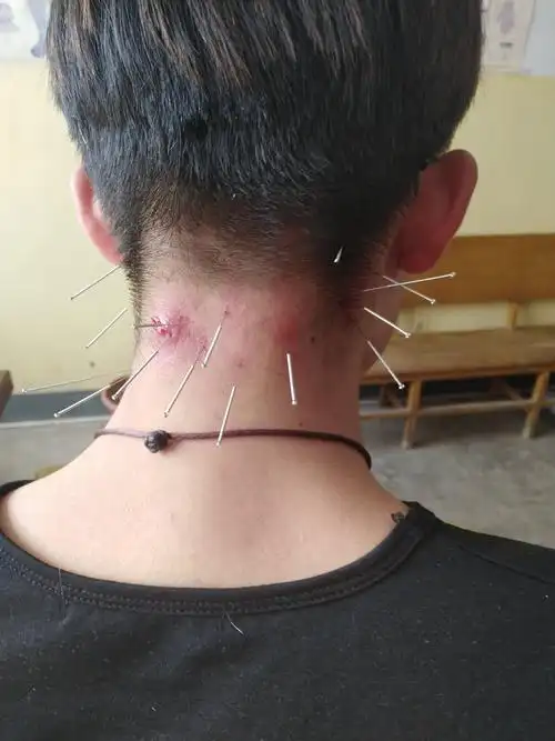 郑大一附院"偷学"陈老师针刺治愈痤疮合并毛囊炎!