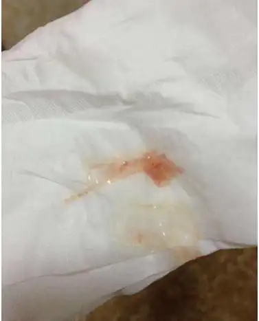 孕晚期见红图片 (1)_有来医生