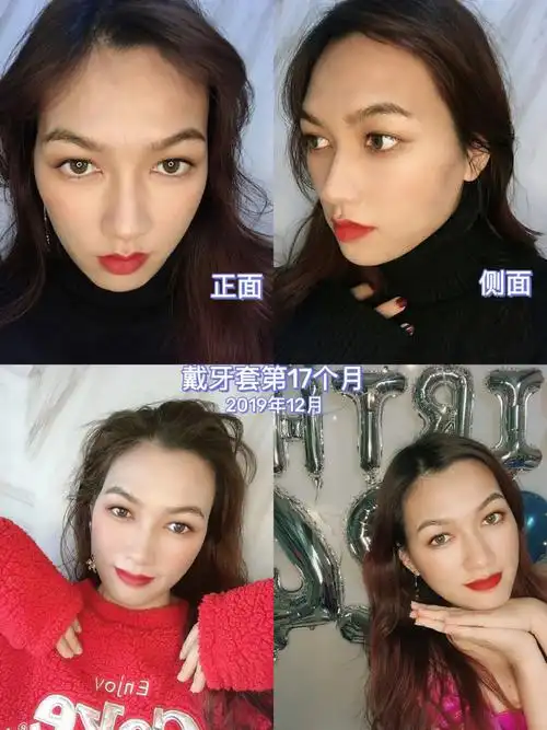 我的正畸前后对比图|戴牙套2年的变化记录