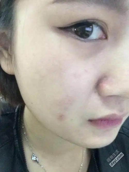 脸部严重过敏,如何维权? - 健康丽人 - 得意生活-武汉生活消费社区